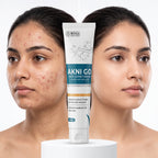 AKNI GO Anti Acne Cream 30g – Acne, Pimples & Breakouts Control Cream