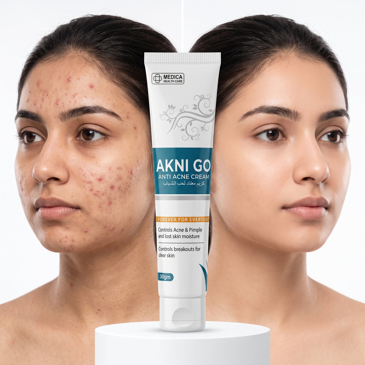 AKNI GO Anti Acne Cream 30g – Acne, Pimples & Breakouts Control Cream